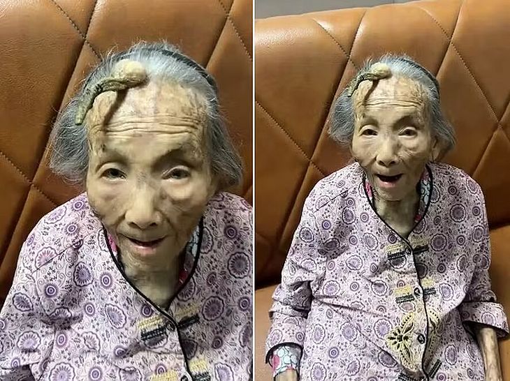 Idosa de 107 anos desperta atenção por 'chifre' crescendo na testa