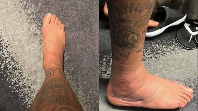 Neymar posta foto de tornozelo inchado durante tratamento na Seleção