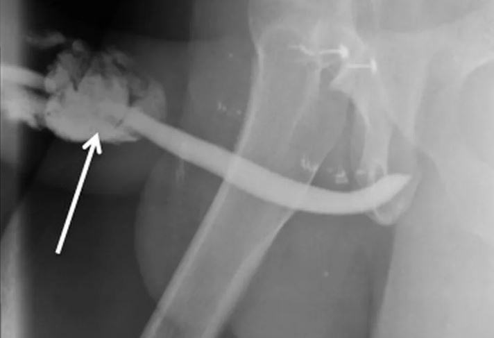 Radiografia do acidente: fraturas atingiram corpos cavernosos do pênis — Foto: Reprodução / International Journal of Surgery Case Reports