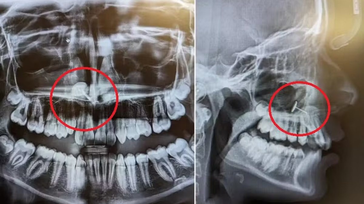 Mãe leva filha adolescente para raio X odontológico e fica chocada com o que descobre