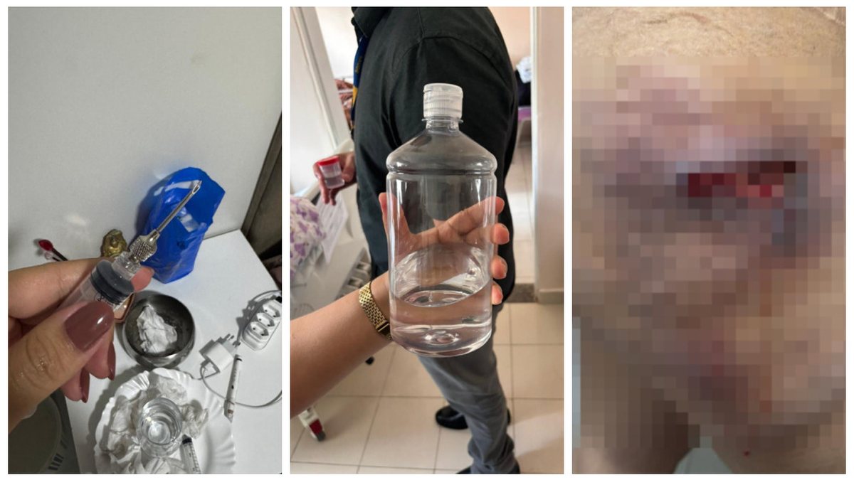 Dentista é suspeita de usar silicone industrial em procedimentos e causar necrose em pacientes