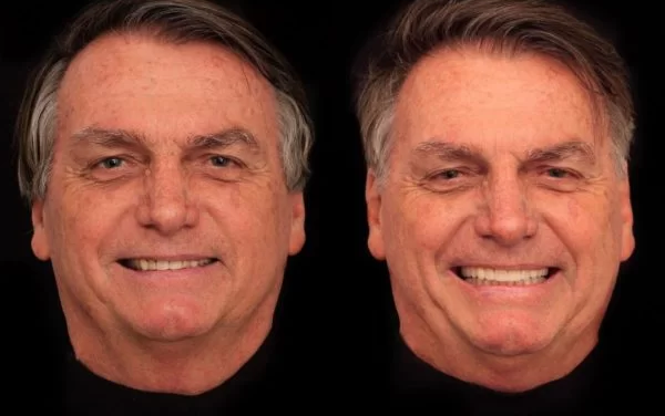 Bolsonaro diz que não pagou por harmonização dentária