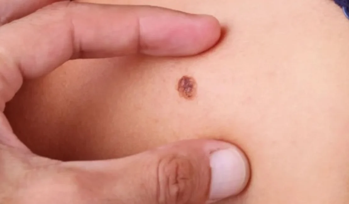 Câncer de pele do tipo melanoma pode causar morte, dizem especialistas - Foto: Reprodução