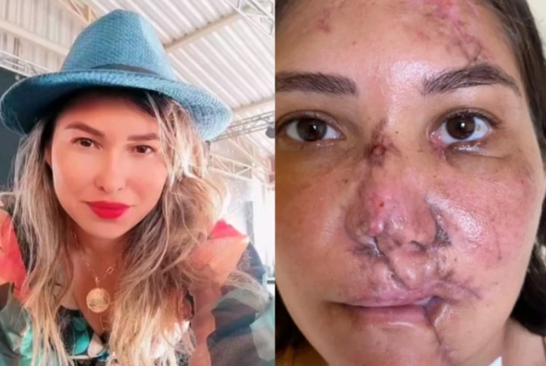 Após acidente de moto, mulher faz 4 cirurgias para reconstruir a face