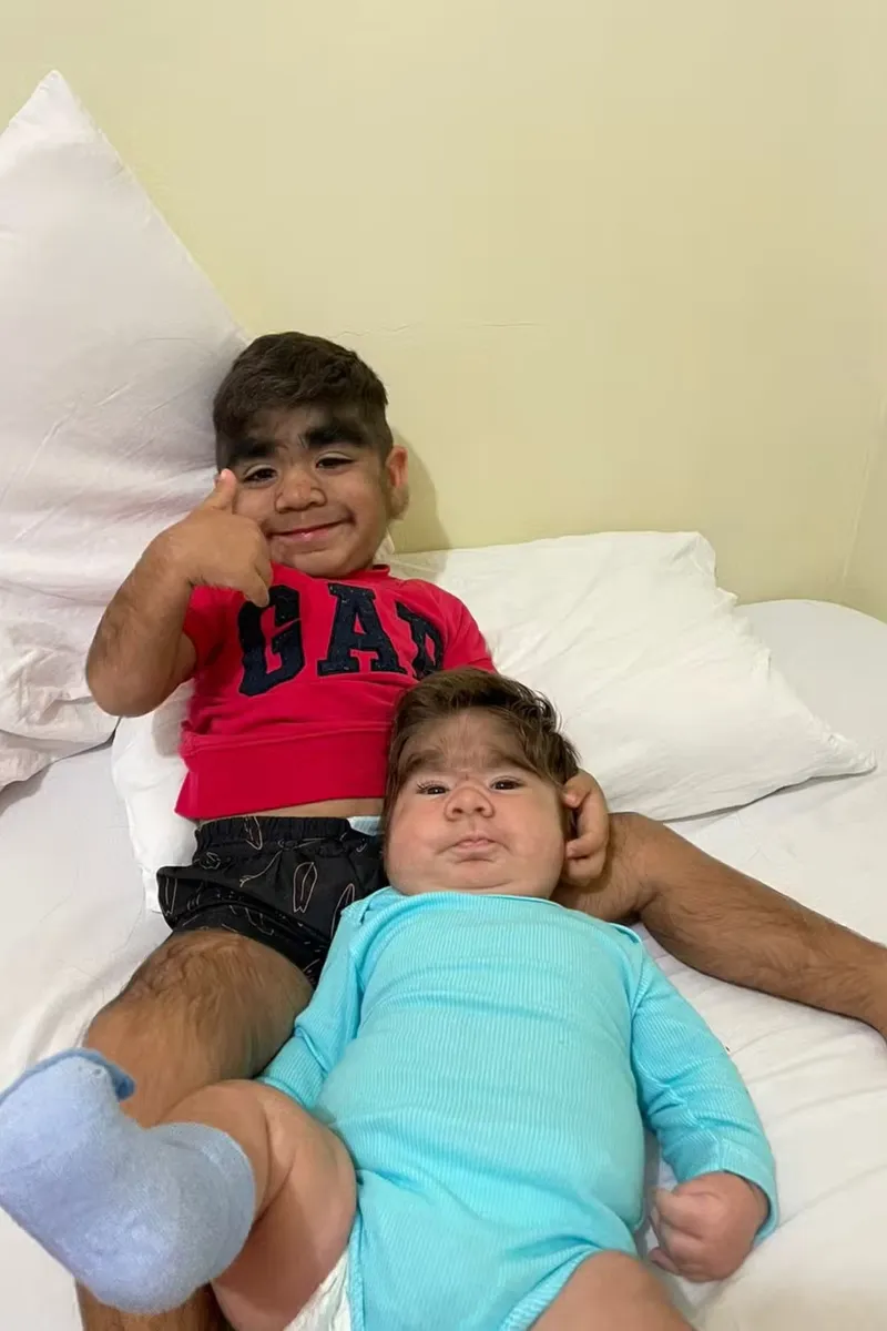Influenciadora dá à luz segundo filho com "síndrome do lobisomem". — Foto: Arquivo pessoal