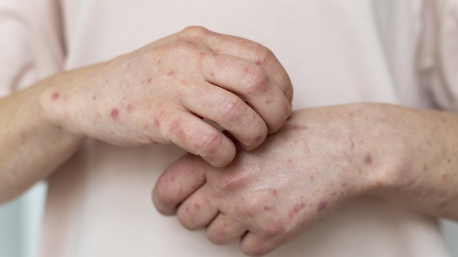 Secretaria de Saúde de Palmeira dos Índios emite alerta sanitário para caso suspeito de sarampo