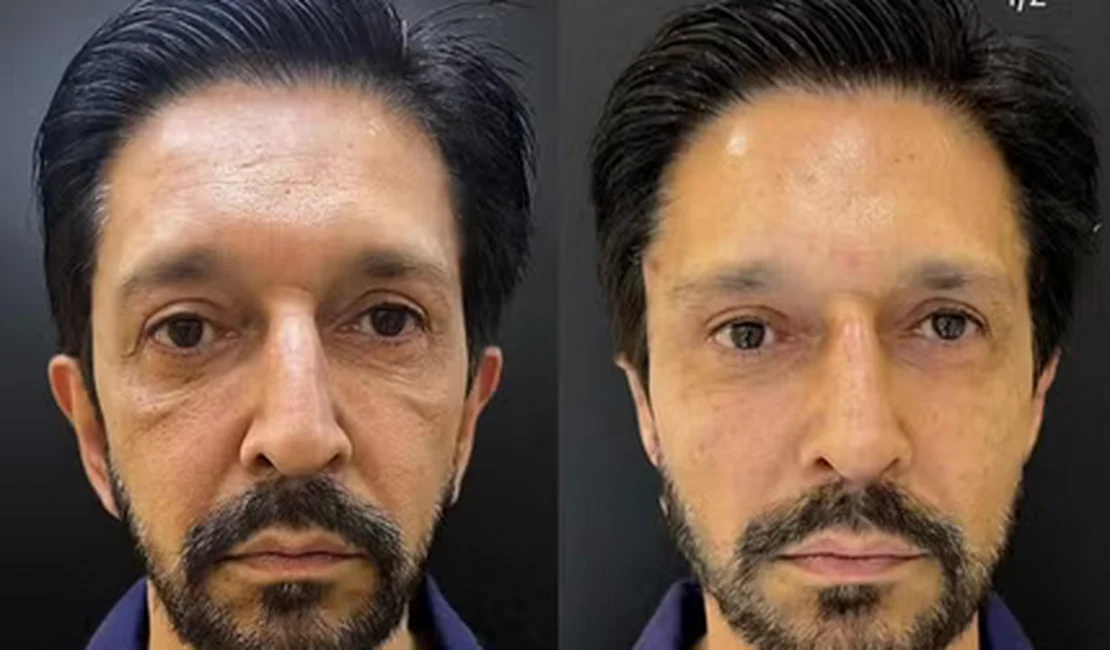 Ricardo Nunes faz harmonização facial, clínica de estética publica 'antes e depois', mas apaga post