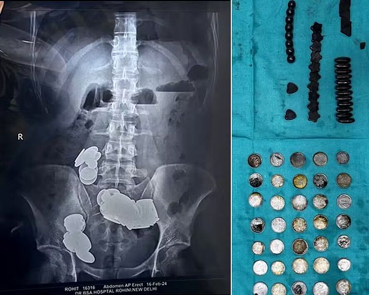 Paciente é operado após engolir 39 moedas e 37 ímãs alegando que 'zinco ajuda na musculação'