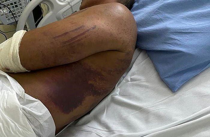 Hematomas no corpo de major da PM | Reprodução/MPGO