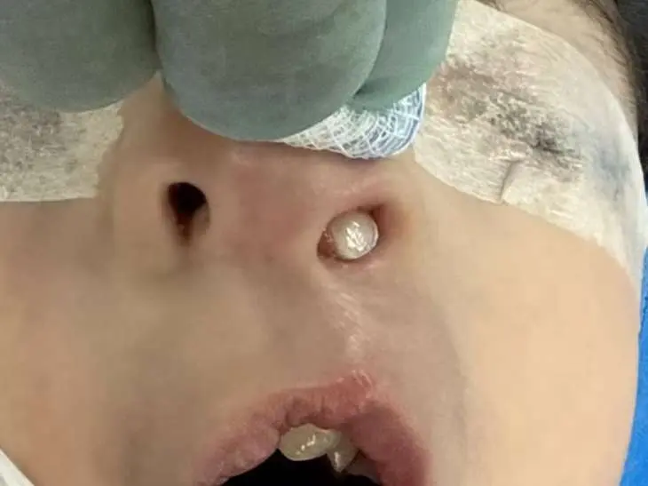 Dente nasce dentro do nariz de criança: “Condição muito rara”