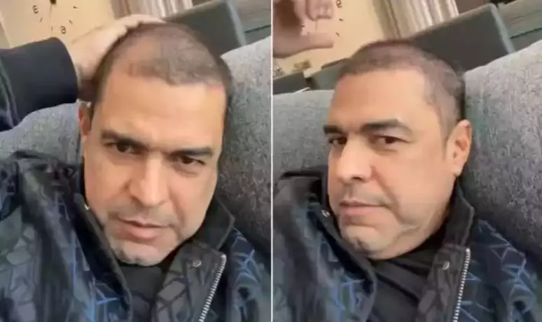 Zezé di Camargo revela que perdeu cabelo após três diagnósticos de covid: 'Nunca fui careca'  