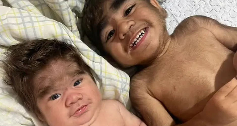Influenciadora dá à luz segundo filho com "síndrome do lobisomem"
