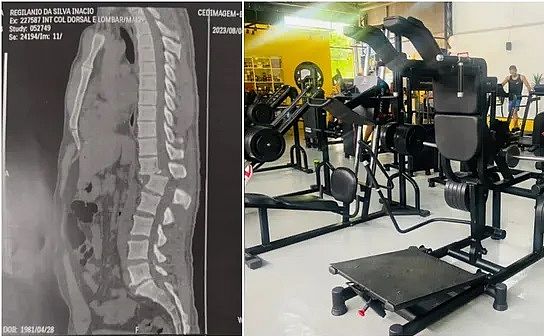 Tomografia mostra lesão na coluna de homem atingido por aparelho em academia no Ceará