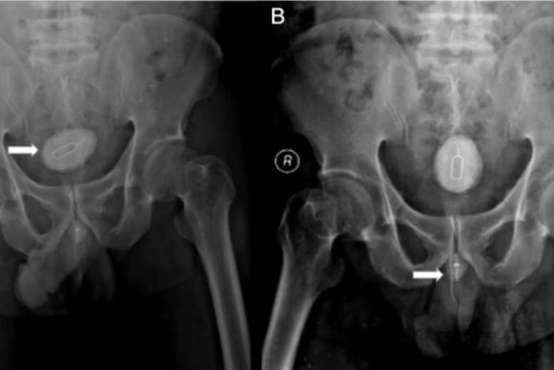 Homem passa por cirurgia após enfiar chave para retirar chip no pênis