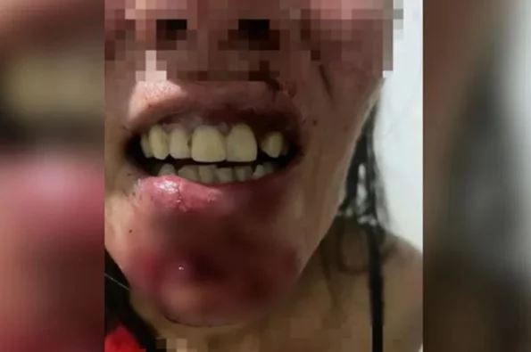 Homem é preso suspeito de agredir a ex com mordidas e marteladas