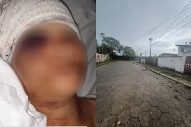 Mulher fica gravemente ferida após ser atacada por cão pitbull na última sexta-feira (25) em Mongaguá, SP — Foto: Reprodução/g1 Santos