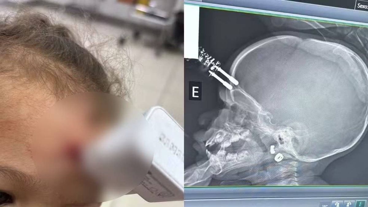 Criança fica com carregador cravado na testa após cair da cama